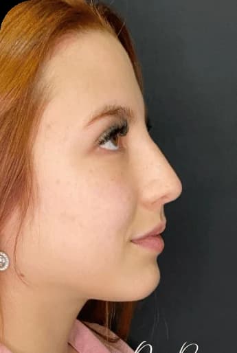 Perfil e contorno — antes