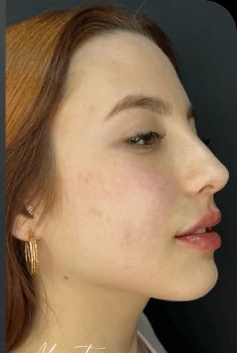 Perfil e contorno — depois